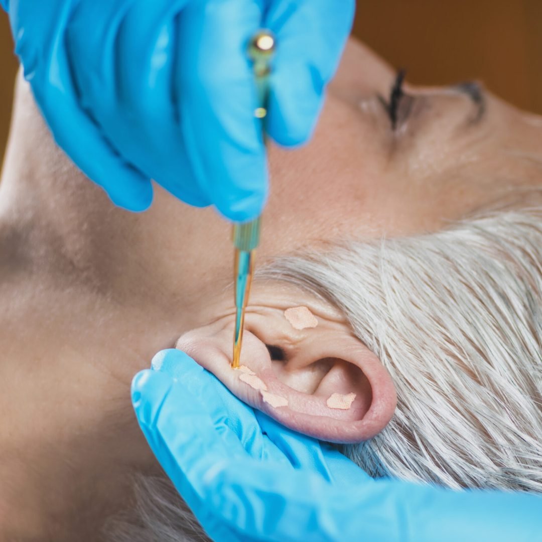 Ear Acupuncture Point Therapy Auriculotherapy, or auricular treatment on human ear, close up. Therapist hand applying acupuncture ear seed sticker with tweezers.